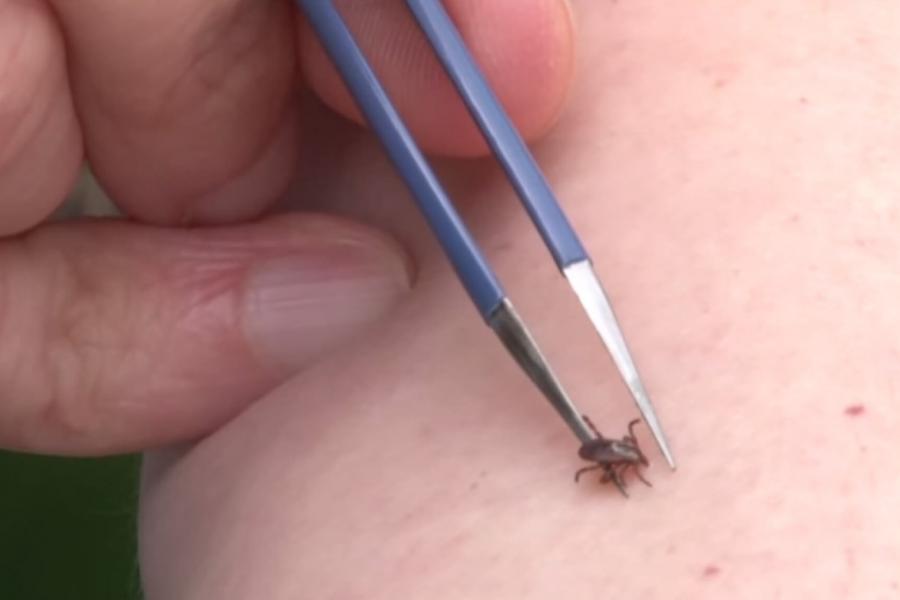 A person demonstrates how to safely remove a tick using tweezers.