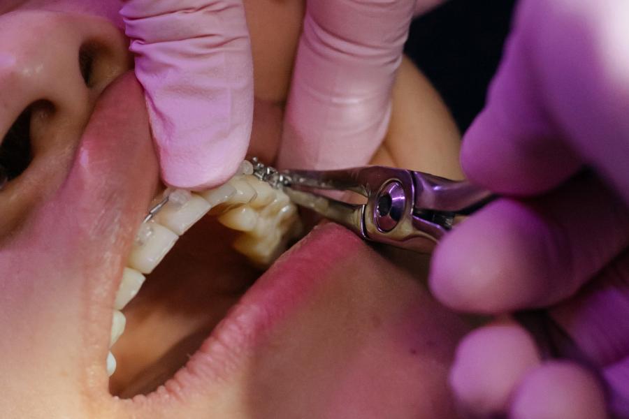 Braces being installed on a patient.