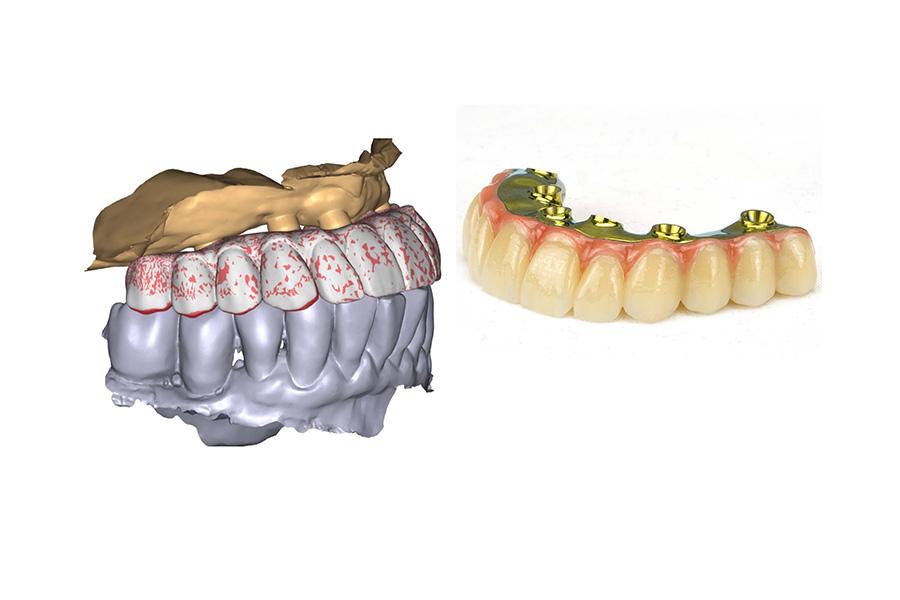 Render of digital dentures