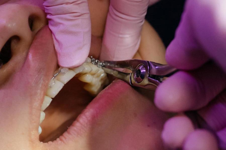 Braces being applied to a patients teeth.