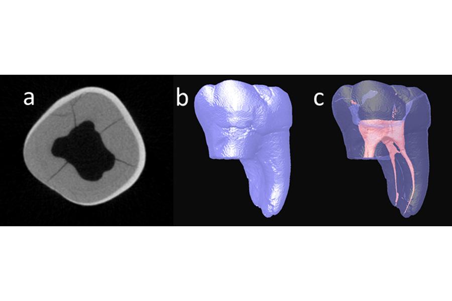 CT scan of an extracted human tooth.