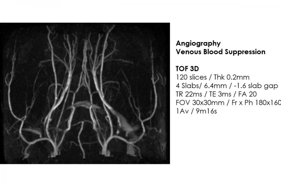 7T MRI Example - MR Angiography.