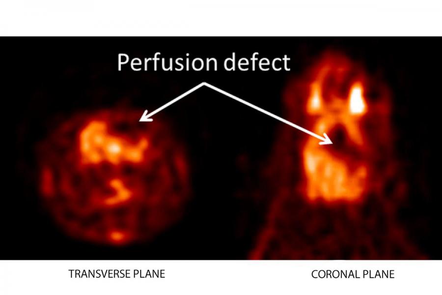 Graphic of cerebral ischaemia