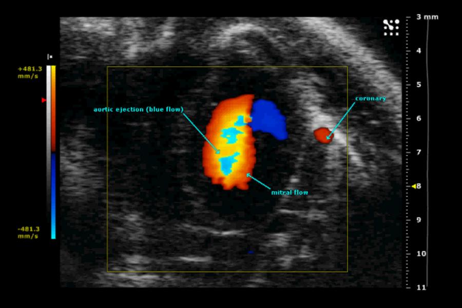 Ultrasound image of mitral valve flow.