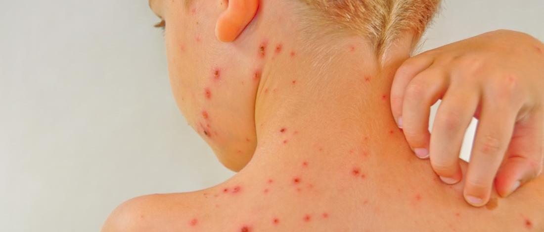 Child with chicken pox on his back.