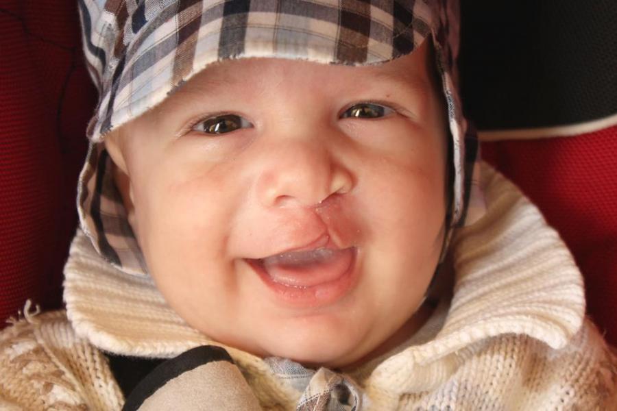 toddler with a cleft palate.